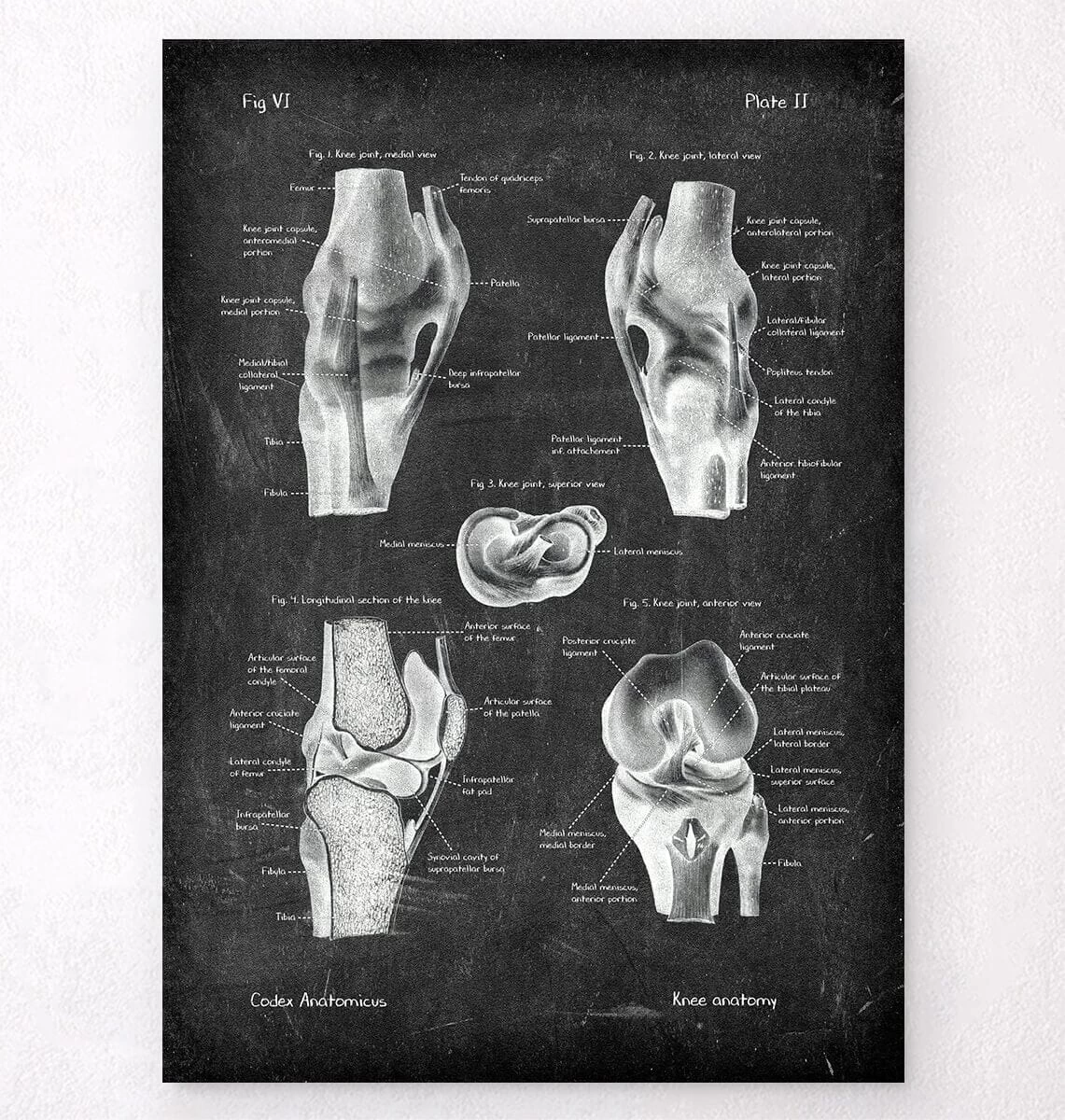 Knee Anatomy Chart - Chalkboard 3 Knee Anatomy Chart - Chalkboard